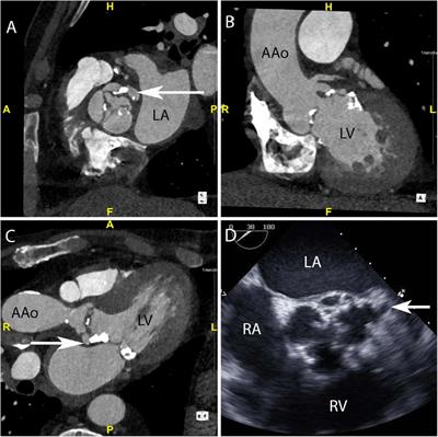 Cardiac computed tomography in infective endocarditis: “bridging the detection gap”